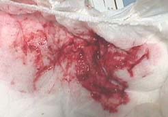 7 腸重積